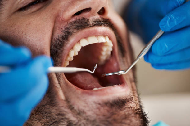 Best Emergency Dental Care for Broken or Chipped Teeth in Torrance, CA
